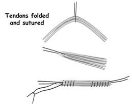 tendons folded and sutured,acl injury,acl reconstruction india,acl reconstruction best india,acl reconstructionbest doctors in india,acl reconstruction best surgeon in india,acl reconstructionbest surgery in india,acl reconstruction best treatment in  india,acl reconstruction in south  india,acl reconstruction north  india,acl reconstruction  east india,acl reconstruction west india,acl reconstruction best in  india,acl reconstruction best surgery in india,acl reconstruction cost-effective in  india,acl reconstruction best doctors in india,acl reconstruction india,acl reconstruction india,acl reconstruction india,acl reconstruction now in india,acl reconstruction india,acl reconstruction by dr.bajaj,acl reconstruction by p.s.bajaj